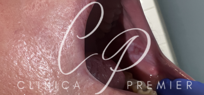 Aftas bucales - Clínica Premier Balear - Dermatologo Palma