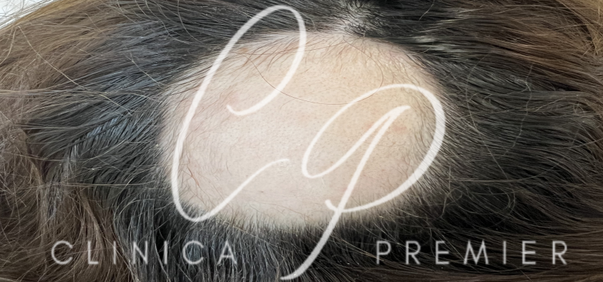 Alopecia areata - Clínica Premier Balear - Dermatólogo Palma de Mallorca Alopecia areata - Clínica Premier Balear - Dermatólogo Palma de Mallorca