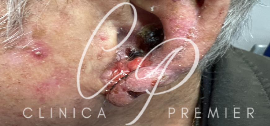 Carcinoma espinocelular (escamoso) - Clínica Premier Balear - Dermatólogo Palma de Mallorca