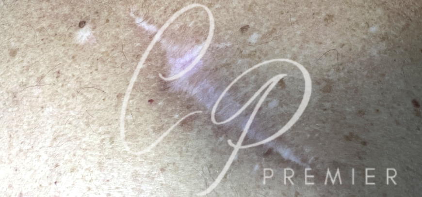 Cicatrices atróficas - Clínica Premier Balear - Dermatologo Palma de Mallorca Cicatrices atróficas - Clínica Premier Balear - Dermatologo Palma de Mallorca