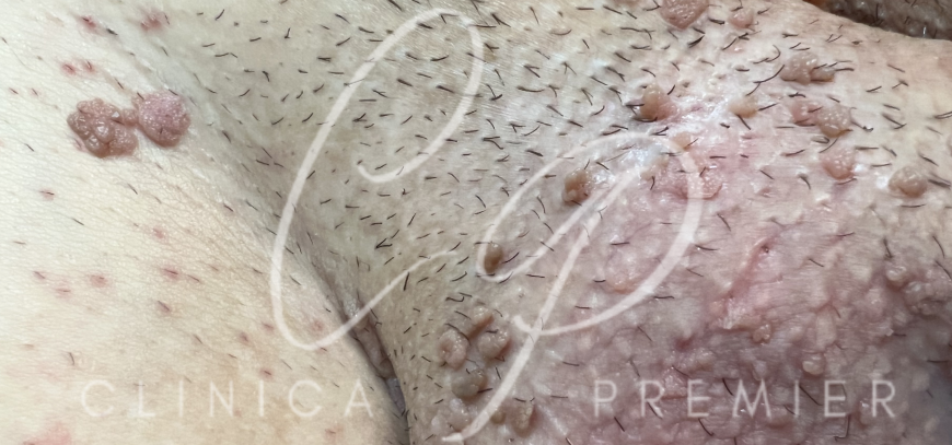 Verrugas genitales - Condilomas - Clinica Premier Balear - Dermatologo Palma Verrugas genitales - Condilomas - Clinica Premier Balear - Dermatologo Palma