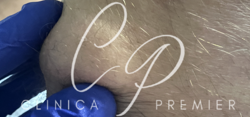 Lipomas - Clínica Premier Balear - Dermatólogo Palma de Mallorca