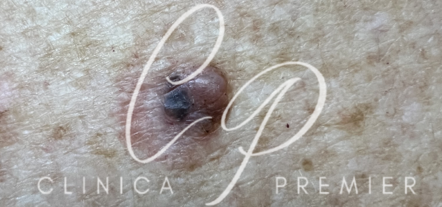 Melanoma maligno - Clínica Premier Balear - Dermatólogo Palma de Mallorca Melanoma maligno - Clínica Premier Balear - Dermatólogo Palma de Mallorca