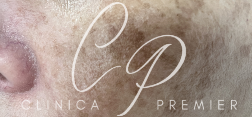 Melasma - Clinica Premier Balear - Dermatólogo Palma de Mallorca Melasma - Clinica Premier Balear - Dermatólogo Palma de Mallorca