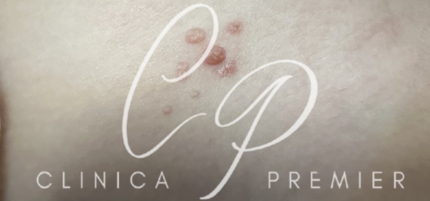 Molluscum contagiosum (Molusco contagioso)- Clínica Premier Balear - Dermatologo Palma de Mallorca