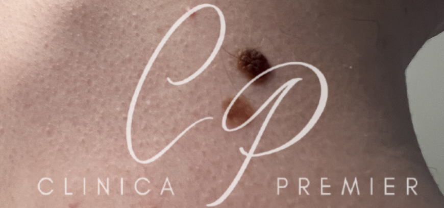 Nevos melanocíticos (lunares) - Clínica Premier Balear - Dermatólogo Palma de Mallorca Nevos melanocíticos (lunares) - Clínica Premier Balear - Dermatólogo Palma de Mallorca