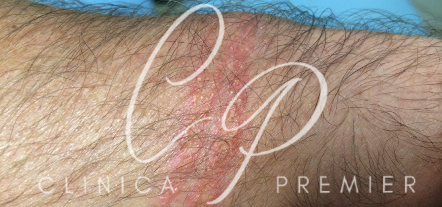 Picaduras de Medusas - Clínica Premier Balear - Dermatólogo Palma de Mallorca Picaduras de Medusas - Clínica Premier Balear - Dermatólogo Palma de Mallorca