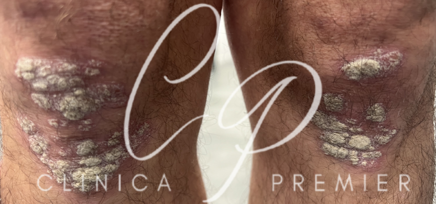 Psoriasis - Clínica Premier Balear - Dermatólogo Palma de Mallorca