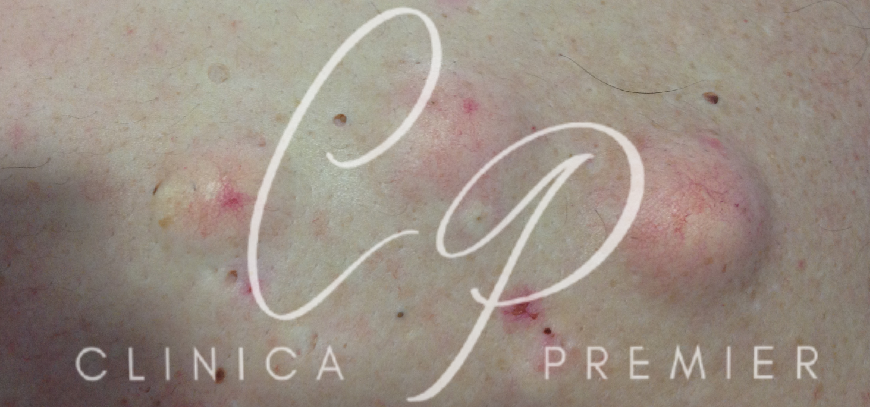 Quistes sebáceos - Clínica Premier Balear - Dermatologo Palma de Mallorca