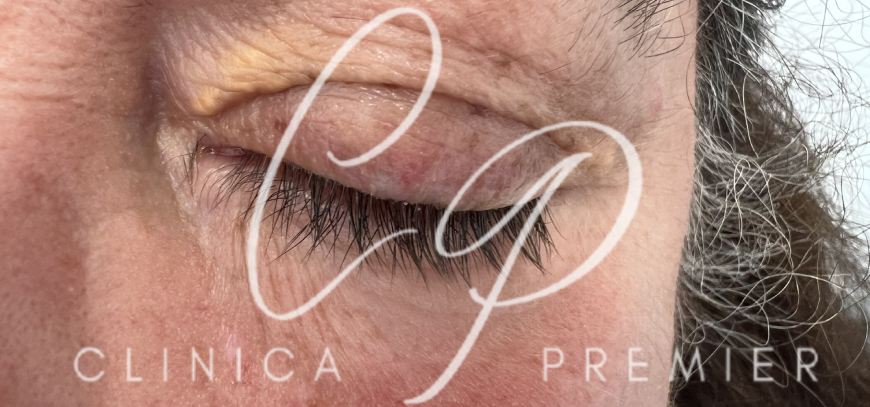 Xantelasma - Clínica Premier Balear - Dermatologo Palma de Mallorca Xantelasma - Clínica Premier Balear - Dermatologo Palma de Mallorca