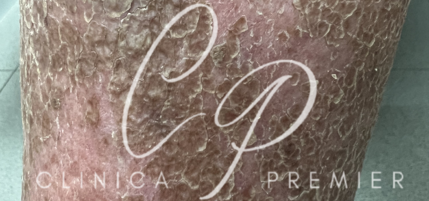 Xerosis - Clínica Premier Balear - Dermatólogo Palma de Mallorca