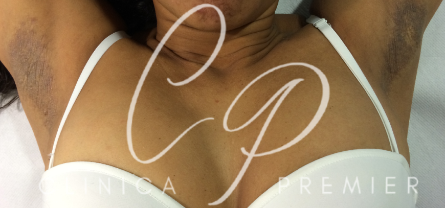 Acantosis nigricans - Dermatológo Palma de Mallorca