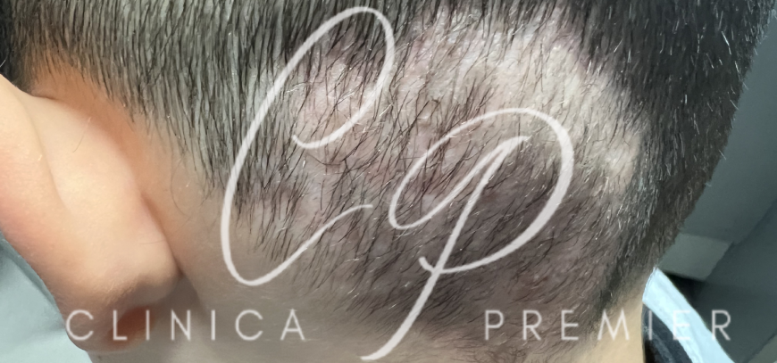 Alopecia Cicatricial - Dermatológo Palma de Mallorca Alopecia Cicatricial - Dermatológo Palma de Mallorca