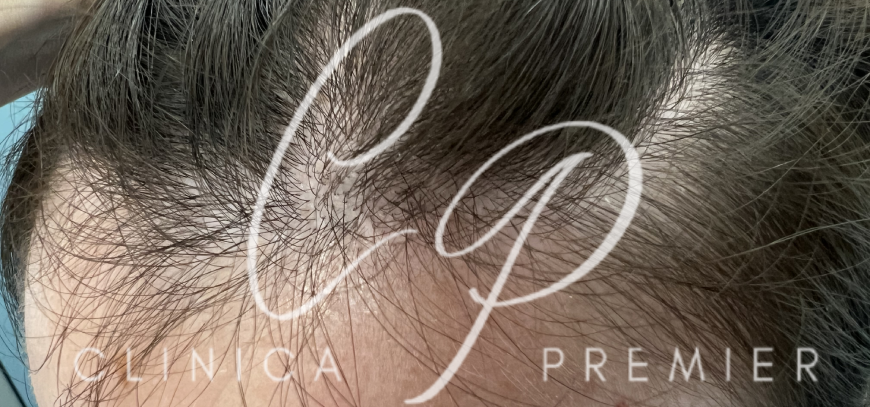 Efluvio telógeno - Dermatológo Palma de Mallorca Efluvio telógeno - Dermatológo Palma de Mallorca
