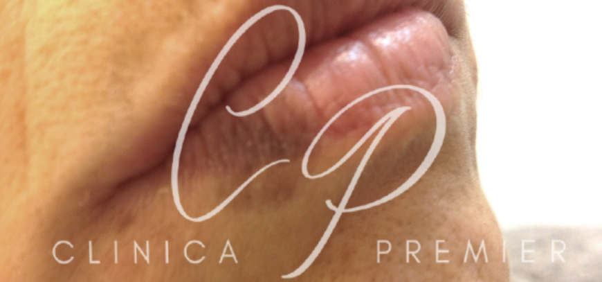 Hiperpigmentación postinflamatoria - Dermatológo Palma de Mallorca - Clínica Premier Balear Hiperpigmentación postinflamatoria - Dermatológo Palma de Mallorca - Clínica Premier Balear