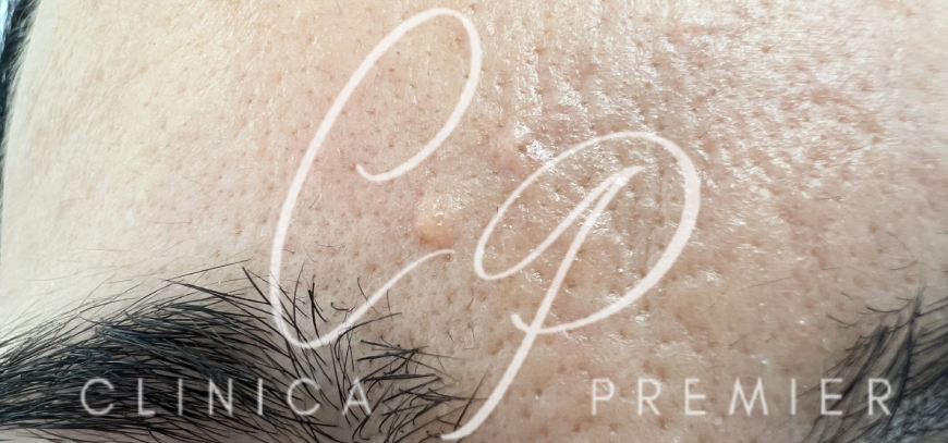 Hiperplasias sebáceas - Dermatológo Palma de Mallorca