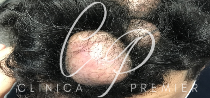 Quistes triquilemales - Dermatólogo Palma de Mallorca