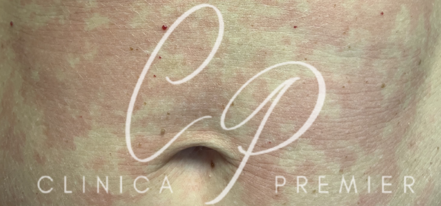 Urticaria - Dermatológo Palma de Mallorca Urticaria - Dermatológo Palma de Mallorca